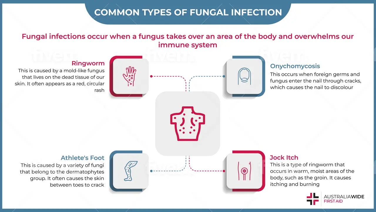 Infographic on Common Types of Fungal Infections