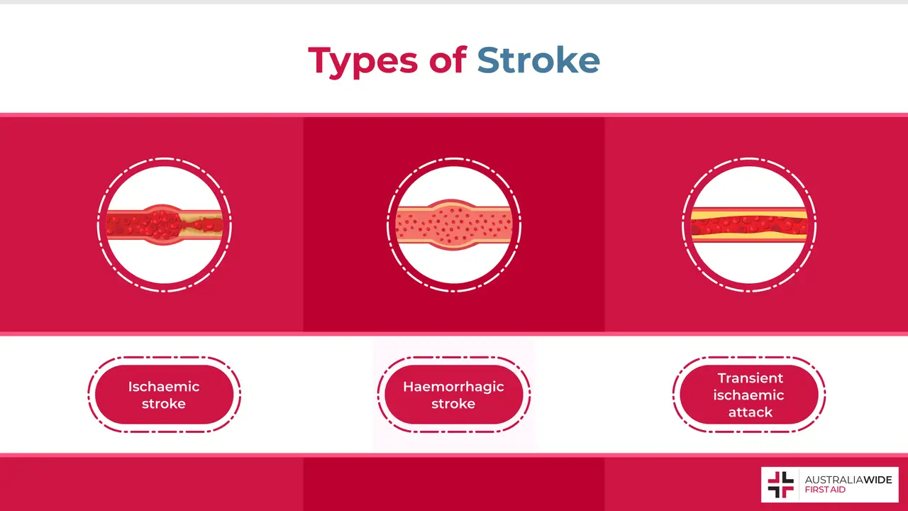 Infographic Showing Three Different Types of Stroke